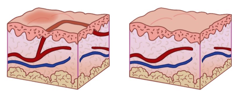 Before and After - Vessels