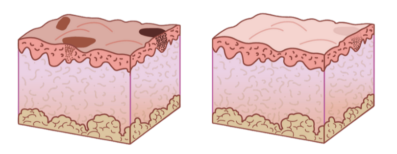Before and After DermaV - Pigment