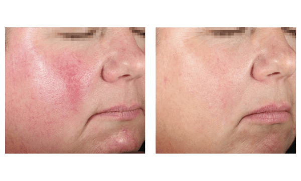 Before and After 3 treatments dermaV