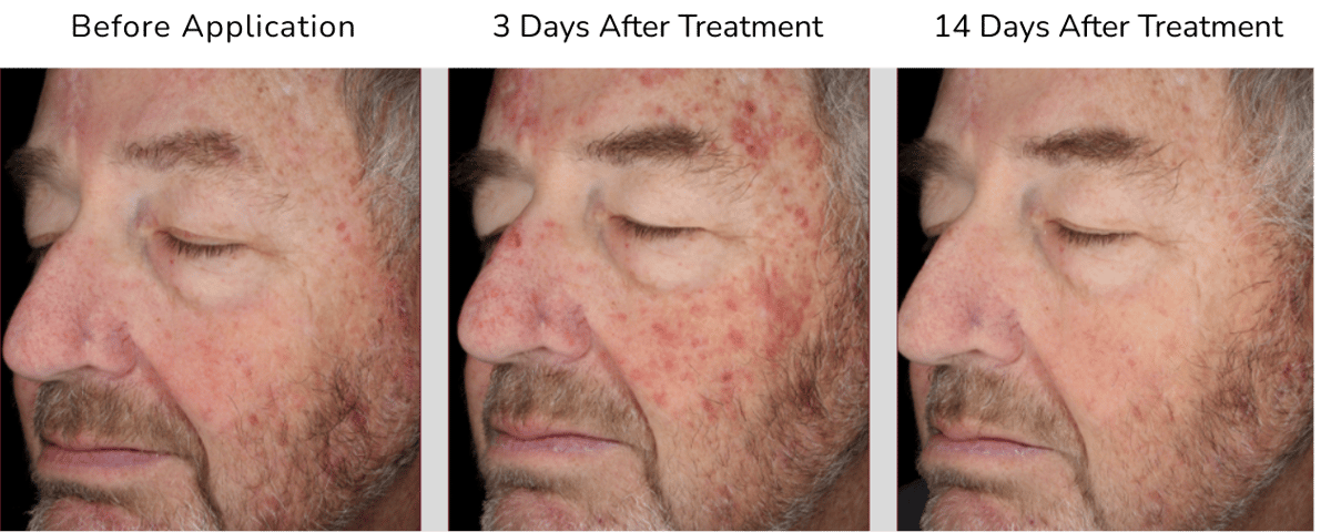 Three images of a man's face, showing before application of Photodynamic therapy, 3 days post treatment, and 14 days post treatment